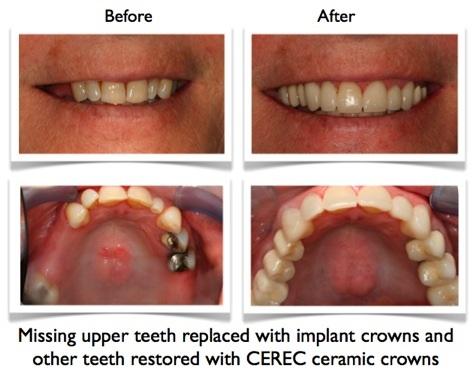 Dental Implant