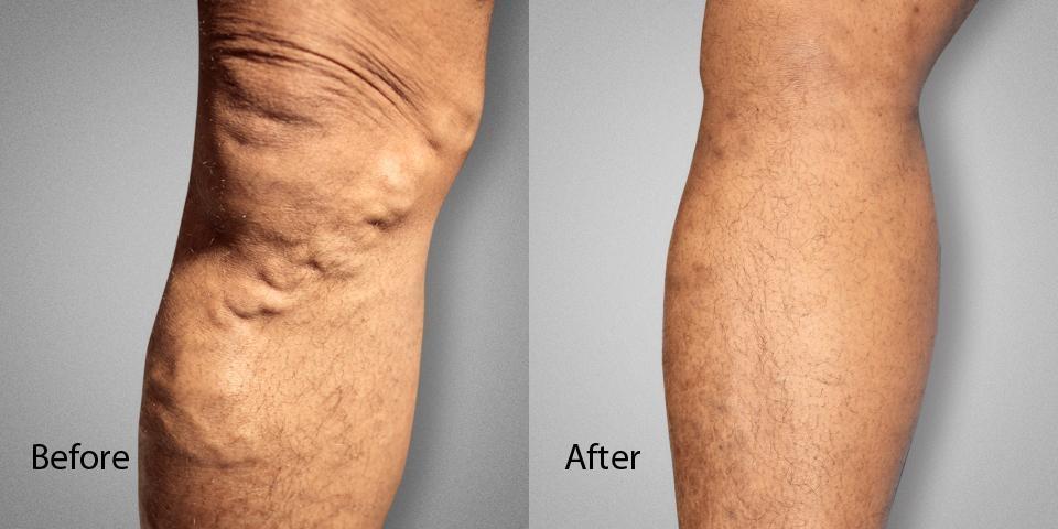 Varicose Vein Before & After male Dr. Ronald Lev