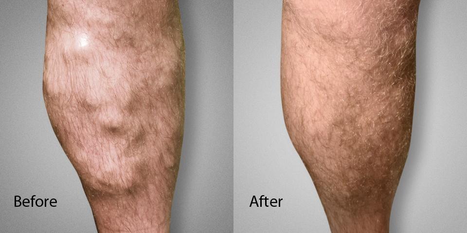 Varicose Vein Before & After male Dr. Ronald Lev