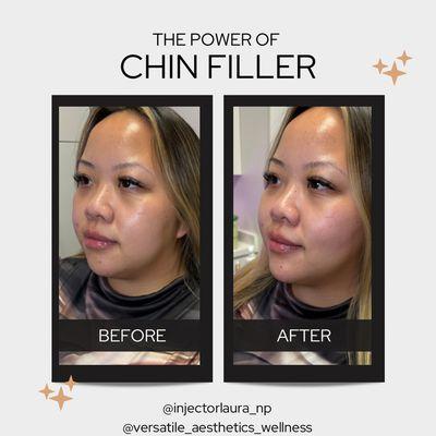 Chin filler can help balance your profile- beautiful, subtle result!