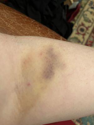 Go to Care Plasma, leave with this. Is anyone *supposed* to have bruises like this after any blood draw whatsoever?