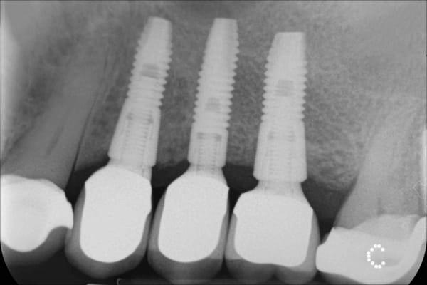 Dental Implant