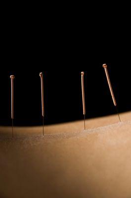 Acupuncture Stress Relief