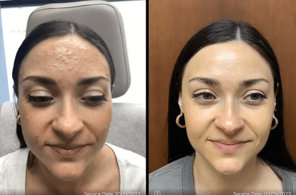 Acne Treatment- Before and After