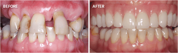 Upper All-on-4® and lower Emax crowns