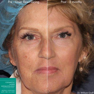 Laser Skin Resurfacing Results Post 5-Months