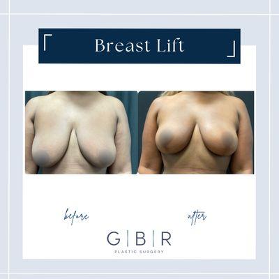 Mastopexy "breast lift"