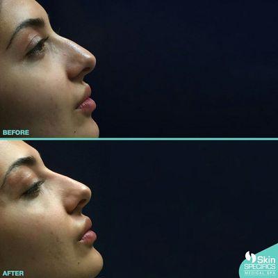 Nose Reshaping with Restylane Lyft - Perlane