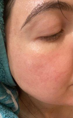 3 days after CO2 fractional laser with Anu!