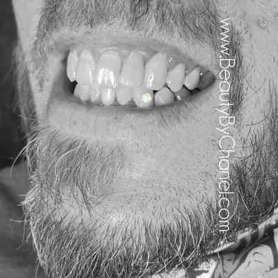 Tooth Bling