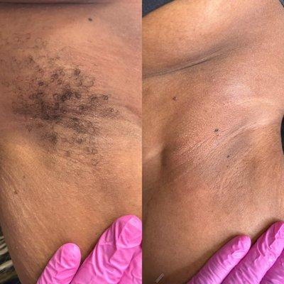 Before and After Underarm Wax