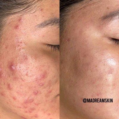 Acne treatment