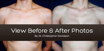 View before & after photos from Dr. Christopher Davidson. Located in Boston, MA at 332 Washington St #100 Wellesley, MA 02481...