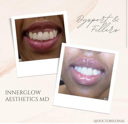 Call us for your lip filler treatment. 860-999-4865