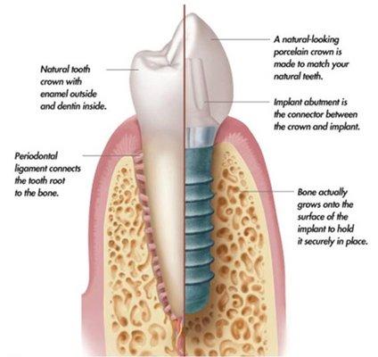 Dental Implants are the best option to mimic the natural tooth.