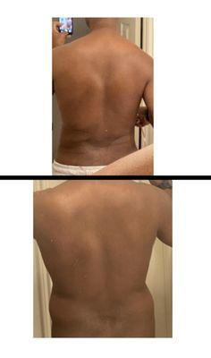 next day results of the liposuction and contouring.