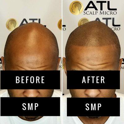 ATL Scalp Micro