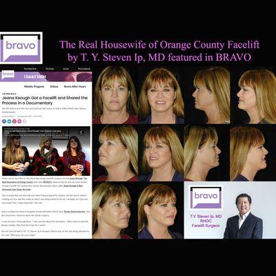 Bravo covers T. Y. Steven Ip, MD, Celebrity NewYork City Park Avenue Plastic Surgeon - Facelift on Real Housewife of OC Star, Jeana Keough