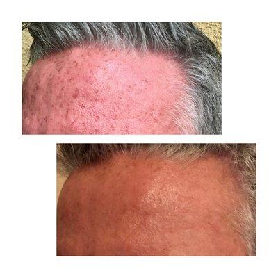 IPL Lumeca- 1 treatment, 2 weeks later