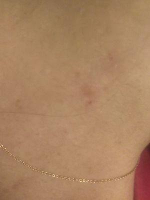 Bed bug bites 3 days after moving in