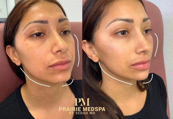 Non surgical facial contouring