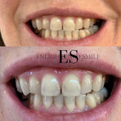 Tetracycline stains corrected.