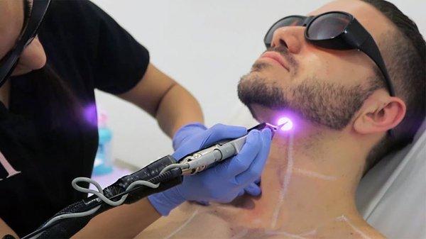 Laser Hair Removal