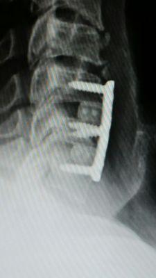 Neck injury with surgical hardware