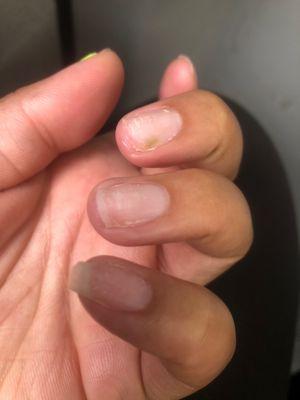 Nail fungus on one of the nails and all my nails broken in barely a week