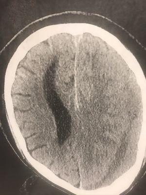 13 ml midline shift following fall and severe brain swelling.