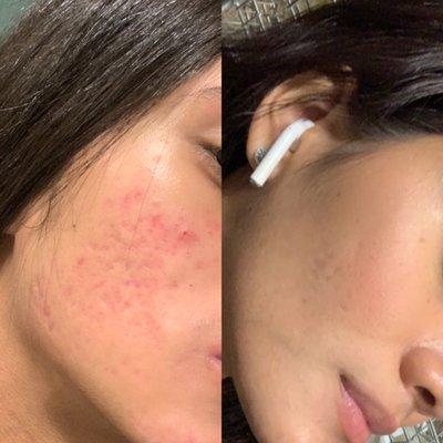 Microneedling before and after-approximately 4 sessions