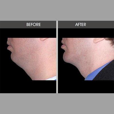 A receding chin may take away from the contours of your jawline. Dr. Antell utilizes chin implants to add natural-looking volume.