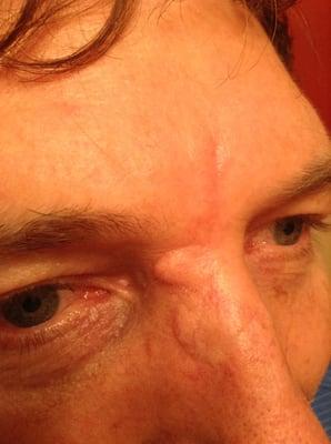 I give Dr. Jerry L. Cooper two stars for the scarring on my nose/forehead after my MOHS surgery. This picture was taken 3 months after.