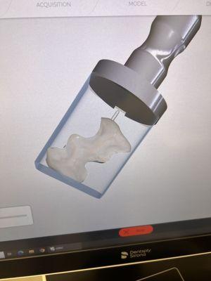 Digital scan of my tooth that creates a 3D model of the partial crown that needs to created