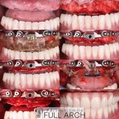 Full arch metal hinge guide products in use for surgery