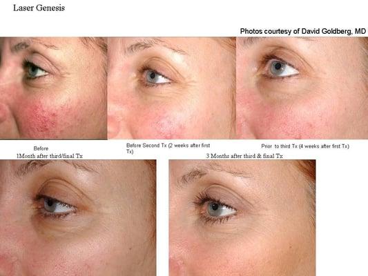 Laser Genesis Skin Rejuvinating, before and after