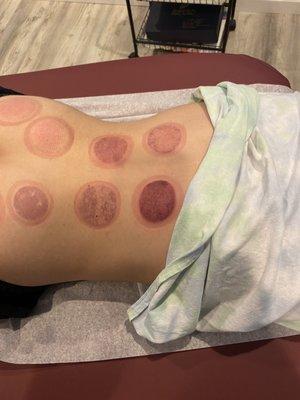 Cupping afterwards