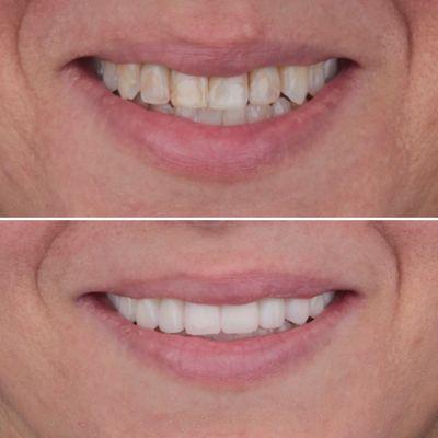 Porcelain Veneers and Crowns