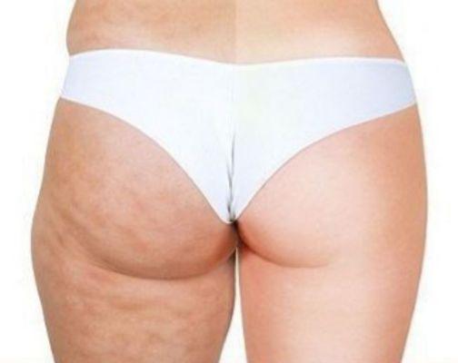 Cellulite Reduction