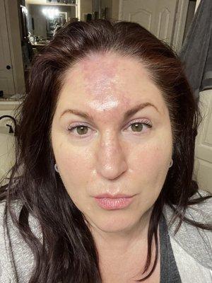 20 units Botox + 1 cc Juvederm on Thur, Jan 19. Skin is dry, peeling & bruised on forehead, nose & inner eyelid. Photos from 1/19 & 1/22.