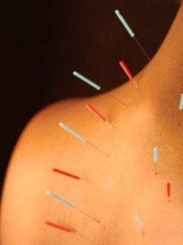 acupuncture