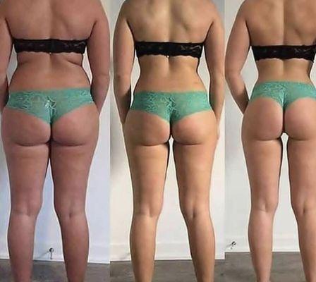 Look at this comparison five treatments of the Brazilian butt lift!