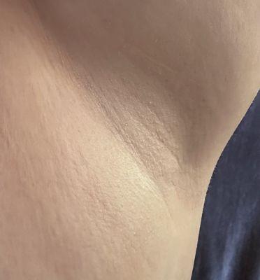 Underarm 1 week after last waxing