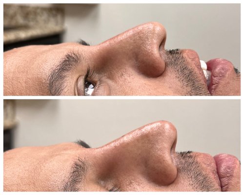 Filler can be used in the nose to enhnace and take away imperfections