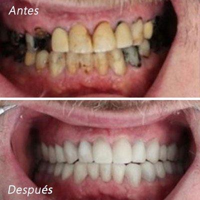 Vista Oasis Smiles - Antes y despues de blanqueamiento dental y colocacion de implantes