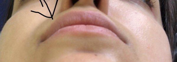 7 months out still uneven, even after dissolving filler.