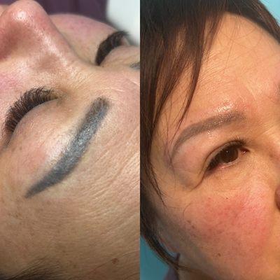 laser eyebrow removal