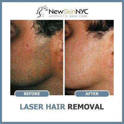 Laser Hair Removal