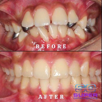 Before and After Treatment Case