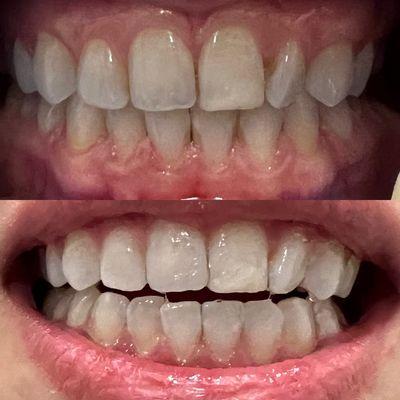 Before & After a 60 mins teeth whitening procedure